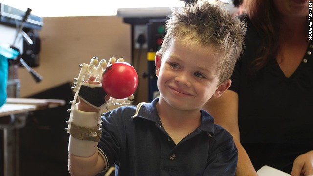 The endless possibilities of 3D prosthetic printing 